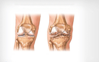 остеоартроз колена